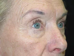 Before Blepharoplasty, Face and Neck lift