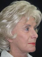 After Blepharoplasty, Face and Neck lift