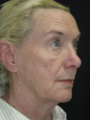 Before Blepharoplasty, Face and Neck lift