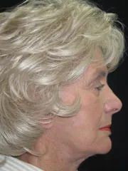After Blepharoplasty, Face and Neck lift