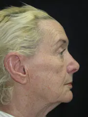 Before Blepharoplasty, Face and Neck lift