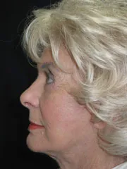 After Blepharoplasty, Face and Neck lift