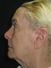 Before Blepharoplasty, Face and Neck lift