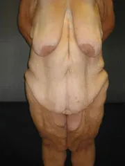 Before Body Contouring After Weight Loss