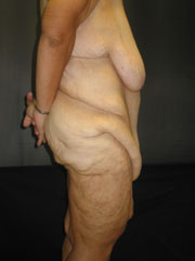 Before Body Contouring After Weight Loss