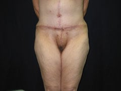 After Body Contouring After Weight Loss