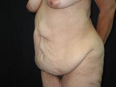 Before Body Contouring After Weight Loss