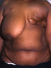 Before Breast Reconstruction with TRAM Flap
