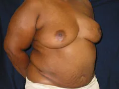 Before Breast Reconstruction with TRAM Flap