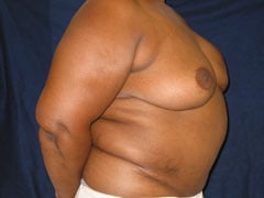 After Breast Reconstruction with TRAM Flap