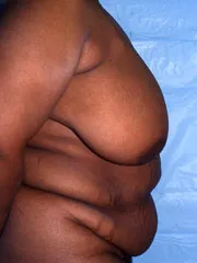 Before Breast Reconstruction with TRAM Flap