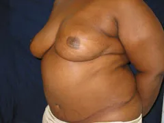 After Breast Reconstruction with TRAM Flap