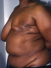 Before Breast Reconstruction with TRAM Flap