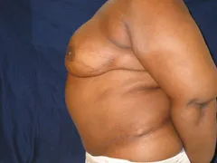 After Breast Reconstruction with TRAM Flap
