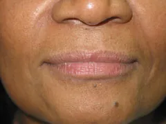 After Restylane
