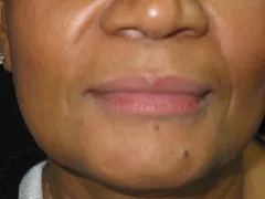 Before Restylane