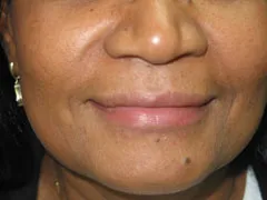 After Restylane