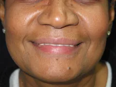 before Restylane
