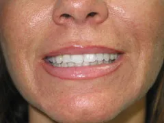 After Restylane