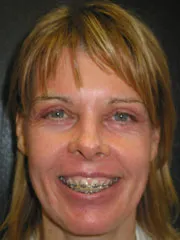 After Blepharoplasty, Laser Resurfacing