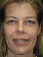 Before Blepharoplasty, Laser Resurfacing