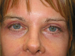 After Blepharoplasty, Laser Resurfacing