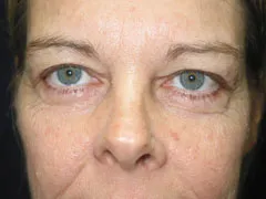 Before Blepharoplasty, Laser Resurfacing