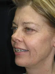 Before Blepharoplasty, Laser Resurfacing