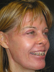 After Blepharoplasty, Laser Resurfacing