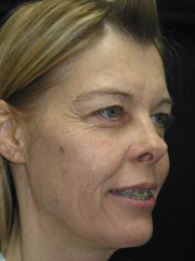 Before Blepharoplasty, Laser Resurfacing