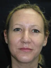 After Rhinoplasty & Genioplasty