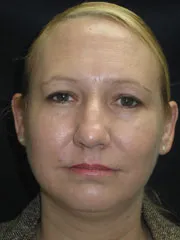 Before Rhinoplasty & Genioplasty