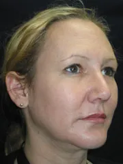 After Rhinoplasty & Genioplasty