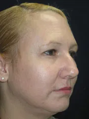 Before Rhinoplasty & Genioplasty