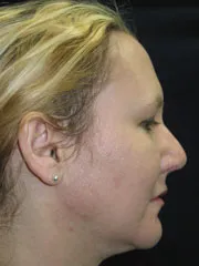 After Rhinoplasty & Genioplasty