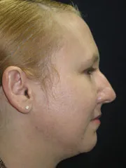 Before Rhinoplasty & Genioplasty