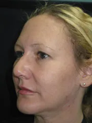 After Rhinoplasty & Genioplasty