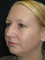 Before Rhinoplasty & Genioplasty