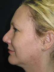 After Rhinoplasty & Genioplasty