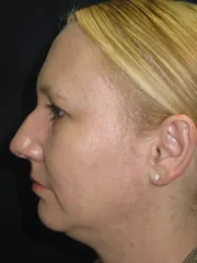 Before Rhinoplasty & Genioplasty