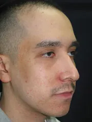 After Rhinoplasty
