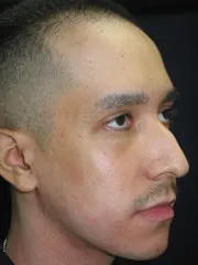 Before Rhinoplasty