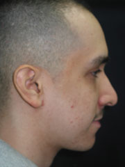 After Rhinoplasty
