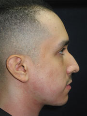 Before Rhinoplasty