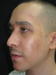After Rhinoplasty