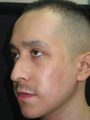 Before Rhinoplasty
