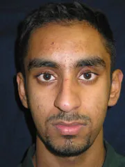 Before Rhinoplasty