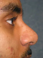 After Rhinoplasty