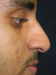 Before Rhinoplasty