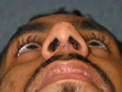 After Rhinoplasty
